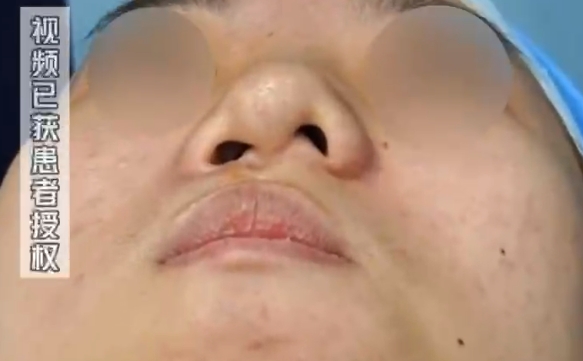 唇裂鼻孔錯位難題解決：效果明顯的余文林醫(yī)生案例 