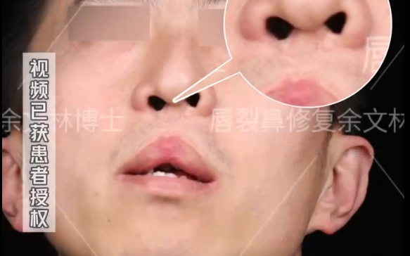 如何解決雙側(cè)唇裂問(wèn)題？余文林醫(yī)生案例分享，擺脫?dān)椬彀愕拇叫?>
        </a></li>
       			<li><a href=