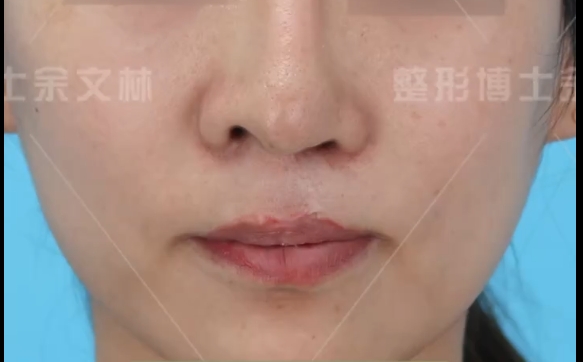余文林醫(yī)生揭秘：美容鼻和唇裂鼻修復(fù)的不同標(biāo)準(zhǔn)