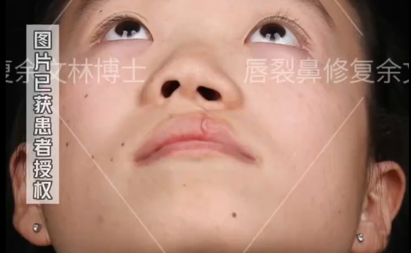 余文林醫(yī)生揭秘：小時(shí)候的唇裂沒(méi)修復(fù)好會(huì)變成怎么樣？