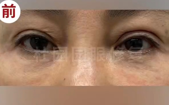 雙眼皮注射脂肪失敗怎么辦？跟隨杜園園醫(yī)生修復(fù)再次美麗