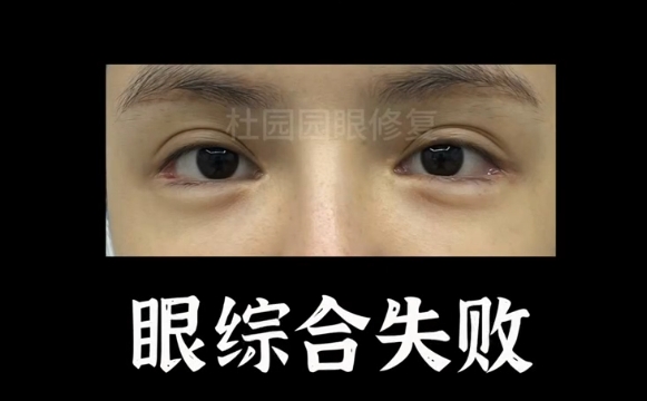 杜園園醫(yī)生揭秘：為什么眼綜合失敗后要避免多個(gè)項(xiàng)目一起修復(fù)？