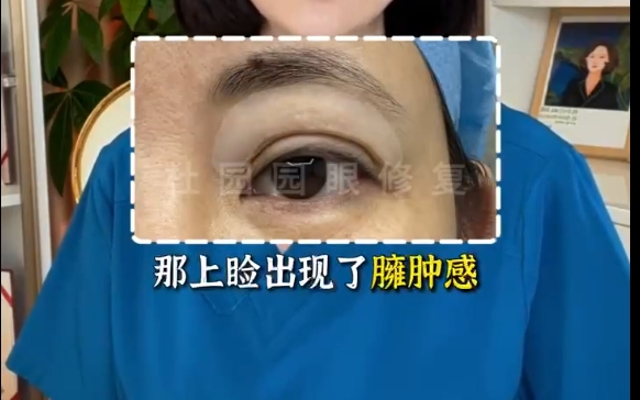 揭秘上眼瞼脂肪注射不滿意的真相！上海愛尚麗格專家解答你為什么
