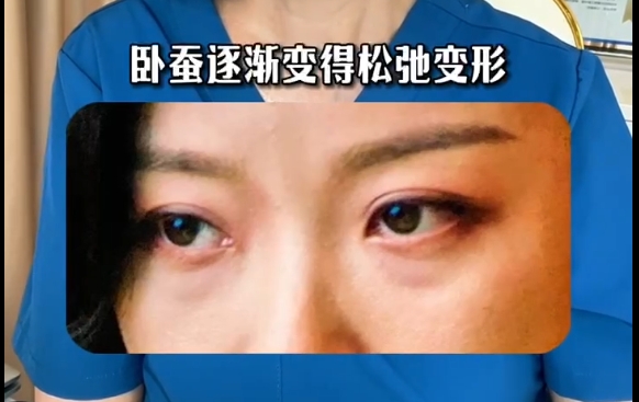 臥蠶變形松弛如何恢復(fù)青春？杜園園醫(yī)生帶你重拾年輕，恢復(fù)自信！