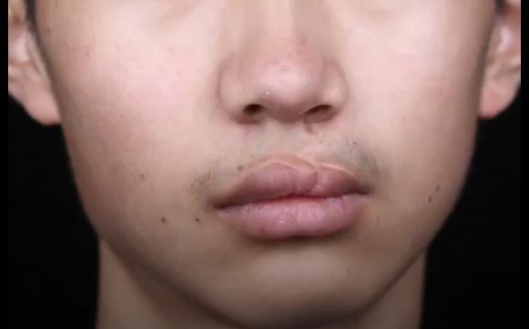 唇裂剛做完，還是不對稱？余文林醫(yī)生案例分享