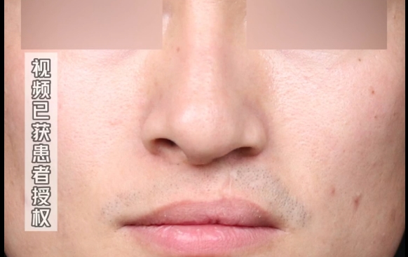 余文林醫(yī)生揭秘：九成以上的唇裂鼻畸形修復(fù)都選擇肋軟骨？