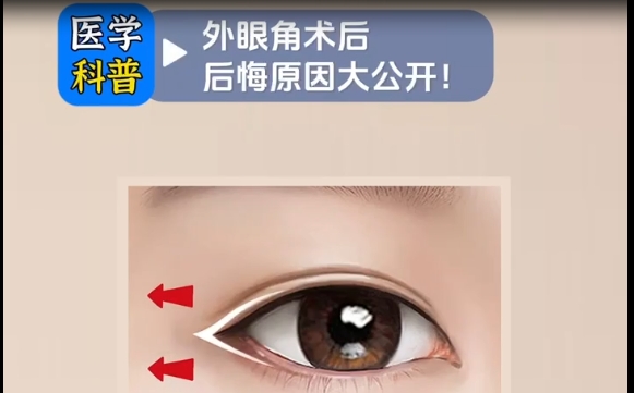 外眼角術(shù)后后悔原因大公開，杜園園醫(yī)生在線分析