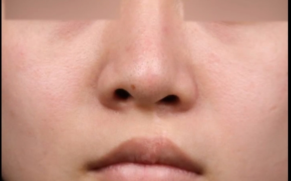 了解唇隱裂修復(fù)：是否需要在小時候進(jìn)行？聽余文林醫(yī)生解析