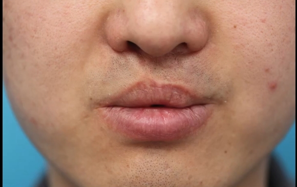 唇形和人中修復(fù)：分開做還是一起進(jìn)行？余文林醫(yī)生解讀 