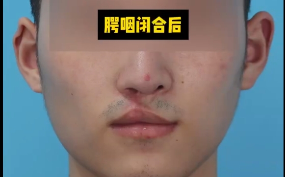 唇腭裂修復(fù)優(yōu)先：先變美還是先矯正？余文林醫(yī)生答案揭秘