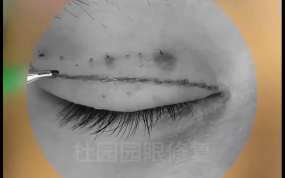 眼修復(fù)不祛皮，原疤痕怎么辦？杜園園醫(yī)生為你解答