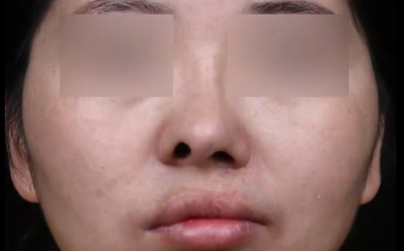 唇裂鼻放膨體后期形狀是否會改變？余文林醫(yī)生給出解答！