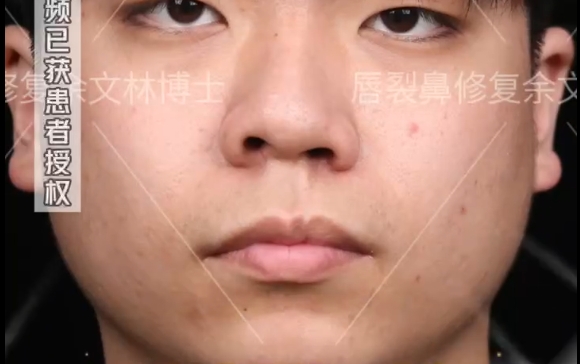 17歲男孩的蛻變：余文林醫(yī)生唇裂鼻修復(fù)案例分享