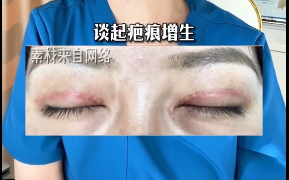 上海愛(ài)尚麗格專家揭秘雙眼皮疤痕手術(shù)增生的真相，不是失敗！