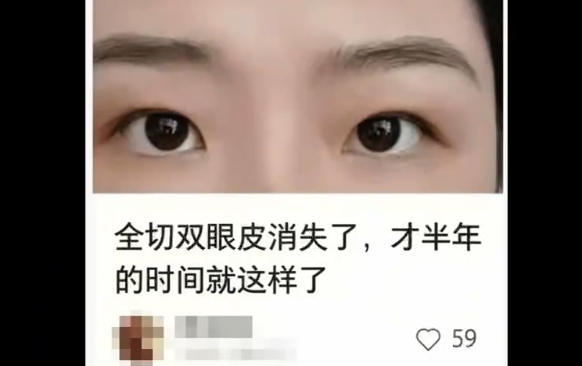 雙眼皮術(shù)后：近期效果 vs. 遠(yuǎn)期效果，杜園園醫(yī)生解析