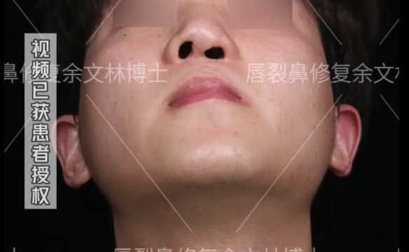 唇裂修復(fù)后的秘密：為什么要戴鼻撐？余文林醫(yī)生解答