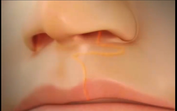 發(fā)現(xiàn)孩子唇裂？不要慌！余文林醫(yī)生的專業(yè)解答 