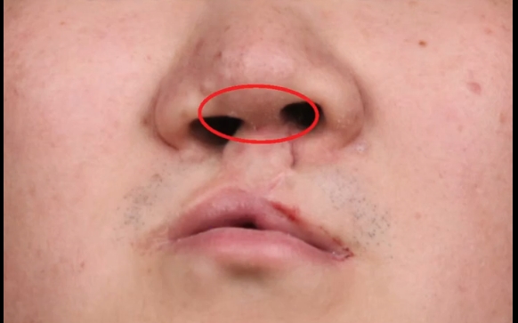 唇裂鼻修復(fù)：去骨VS不取骨，余文林醫(yī)生解析真相