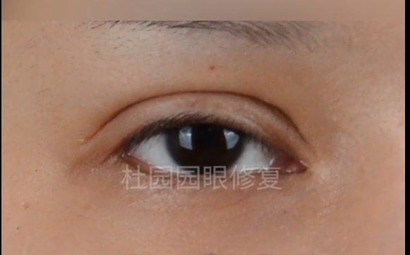 中重度上瞼下垂修復(fù)后為什么會(huì)復(fù)發(fā)？杜園園醫(yī)生揭秘真相！