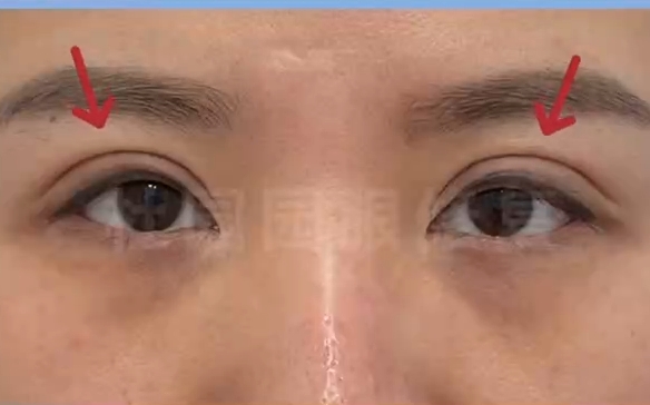 擺脫眼尾下垂煩惱！全面解析杜園園醫(yī)生的方法