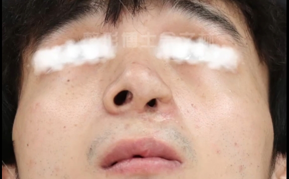 唇裂鼻修復(fù)：為何結(jié)果塌了？余文林醫(yī)生解析 