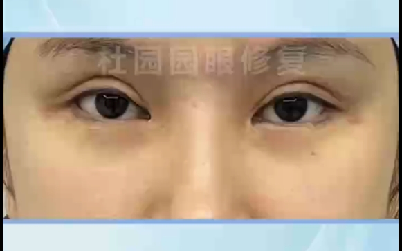 杜園園醫(yī)生親授雙眼皮新月型改善秘笈，讓你眼神閃亮 