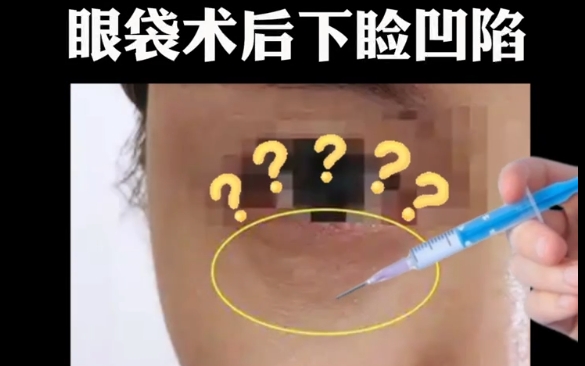 解密眼袋術(shù)后下瞼凹陷，注射是解決之道嗎？杜園園醫(yī)生揭秘 