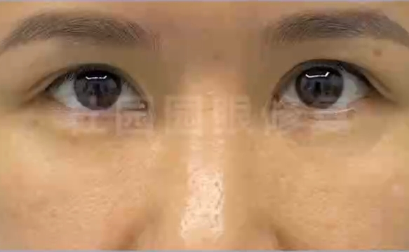 修復(fù)雙眼皮失敗問(wèn)題，上海愛(ài)尚麗格專家助您重獲美麗