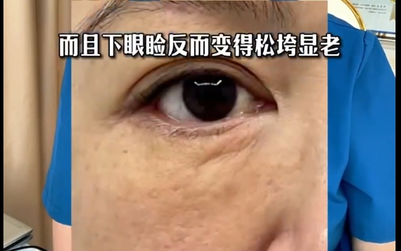 探究眼袋術(shù)后下瞼松垮的真正原因，杜園園醫(yī)生詳細(xì)解析 