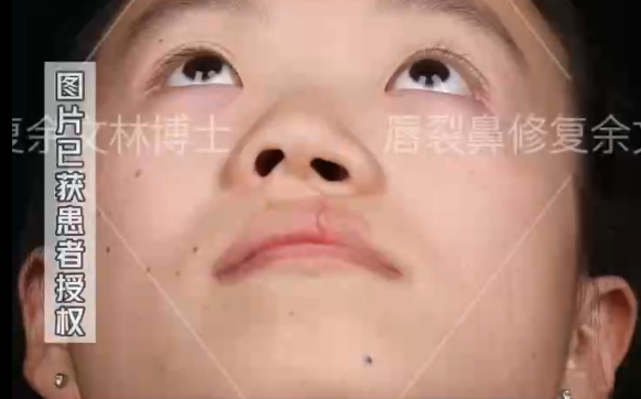 小時候的唇裂沒修復(fù)好會變成怎樣？余文林醫(yī)生解析