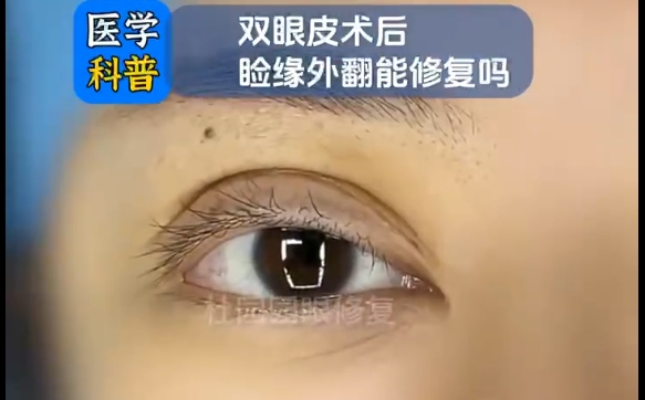 杜園園醫(yī)生分享：雙眼皮術(shù)后瞼緣外翻有解決辦法嗎？