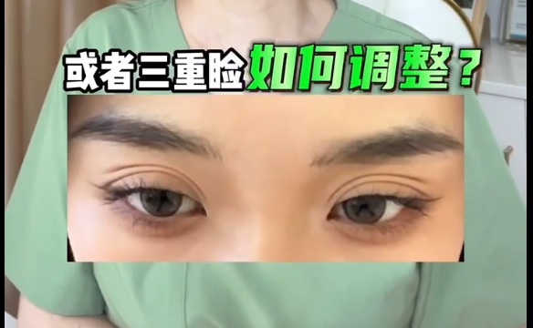 雙眼皮術(shù)后多重瞼困擾？杜園園醫(yī)生揭秘調(diào)整技巧