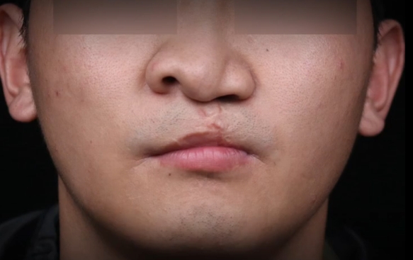 嚴(yán)重唇裂鼻，口鼻漏1.5cm怎么辦？余文林醫(yī)生帶您揭秘