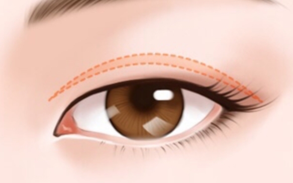 杜園園醫(yī)生教你正確看待眼修復(fù)期早期腫脹 