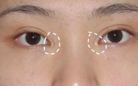 包完內眼角后為何會出現(xiàn)空心洞？杜園園醫(yī)生解答
