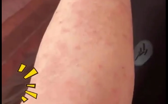 超敏體質，可以吸脂嗎？程辰醫(yī)生告訴你~