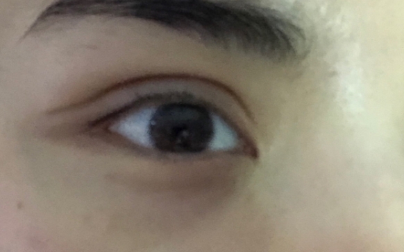 雙眼皮眼尾下垂，延長切口就能解決？杜園園醫(yī)生解答