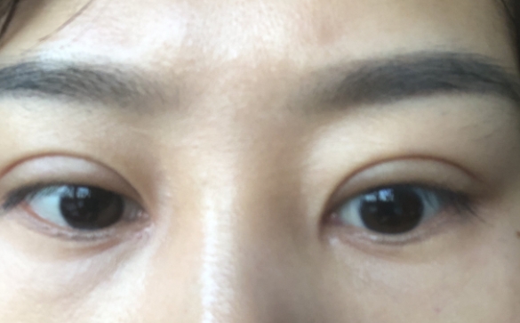 雙眼皮深如何修復，降窄能解決問題嗎？杜園園醫(yī)生回答你