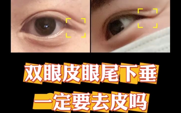 雙眼皮眼尾下垂一定要去皮嗎？杜園園醫(yī)生告訴你答案