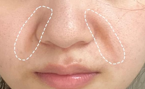 法令紋填充不想移位和猴化，要注意四種情況