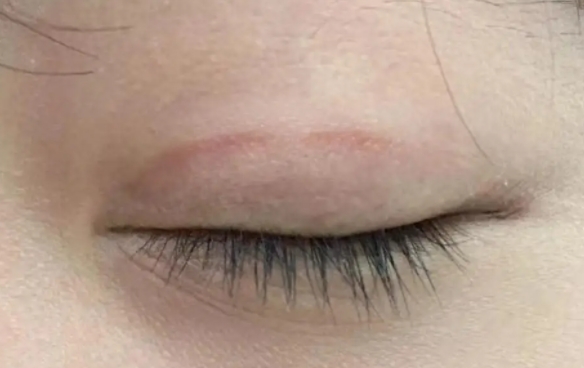 雙眼皮疤痕修復(fù)，原疤痕還會存在嗎？杜園園醫(yī)生解析