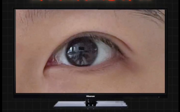 天生狹長的內眼角，開大要注意什么？杜園園醫(yī)生解答