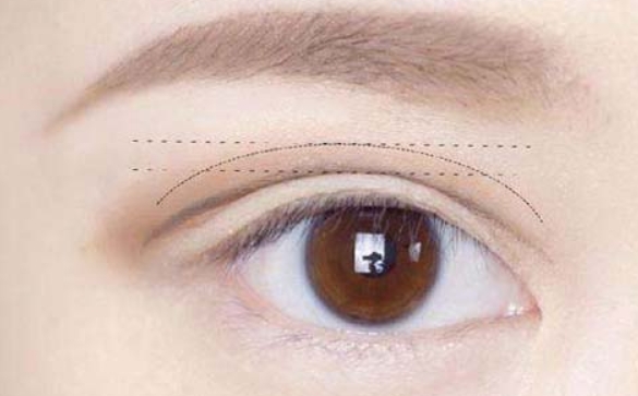 雙眼皮修復(fù)：次數(shù)限制真的存在嗎？杜園園醫(yī)生解答