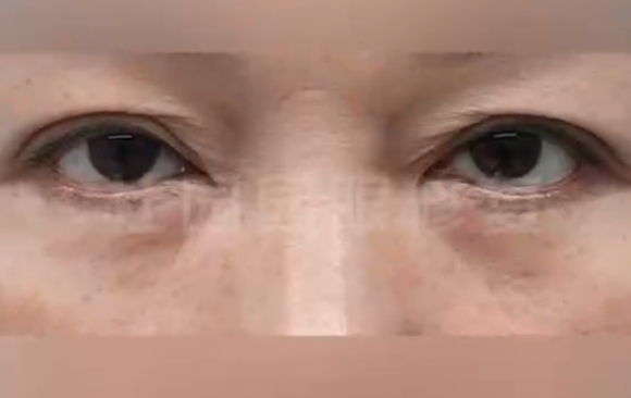 你的雙眼皮有“包子褶”的煩惱嗎？杜園園醫(yī)生案例分享