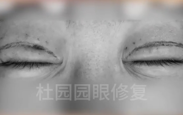 雙眼皮凹陷疤痕，里面發(fā)生了什么？杜園園醫(yī)生在線解答