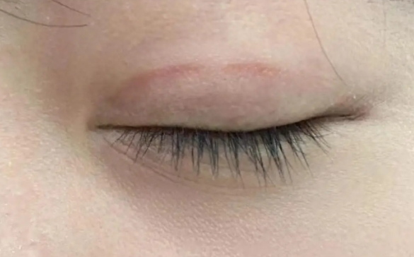 雙眼皮術(shù)后疤痕增生怎么辦？杜園園醫(yī)生在線解答