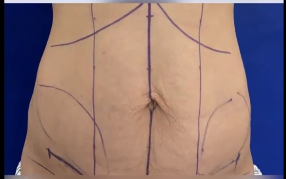 腰腹吸脂，能做出古力娜扎的腰嗎？