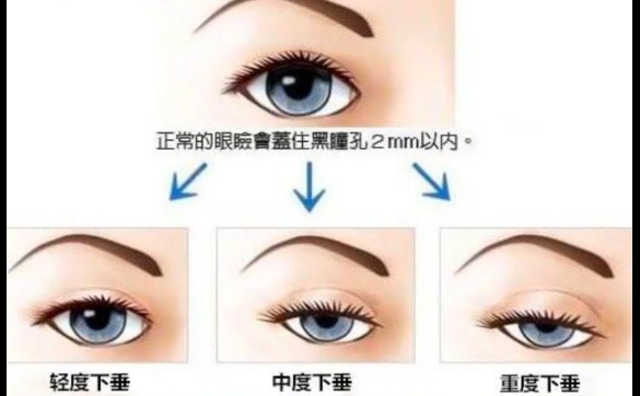 上瞼下垂是全麻嗎？怎么配合？周顯玉醫(yī)生解答