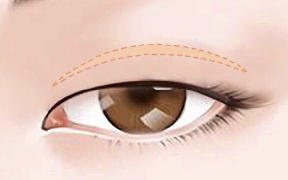 你懷疑的上瞼下垂，可能是假性，無需手術(shù)