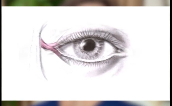 開外眼角失敗后，眼瞼眼球不貼合的原因。杜園園醫(yī)生告訴你